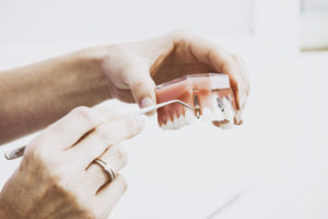 Dental Implant at Cross Street Dental Galway